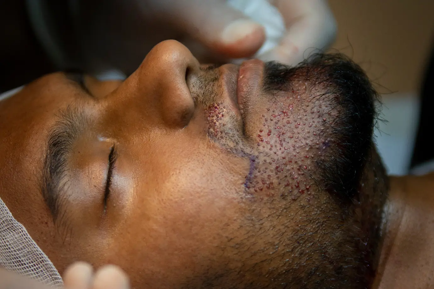 Beard and Mustache Transplantation