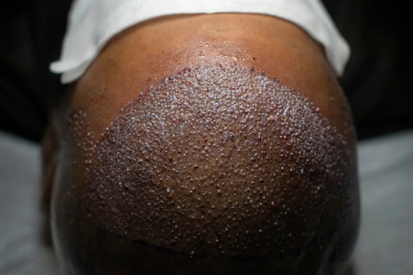 African Hair Transplant