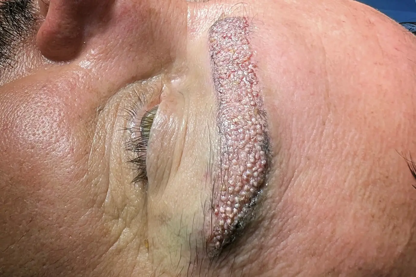 Eyebrow Transplantation