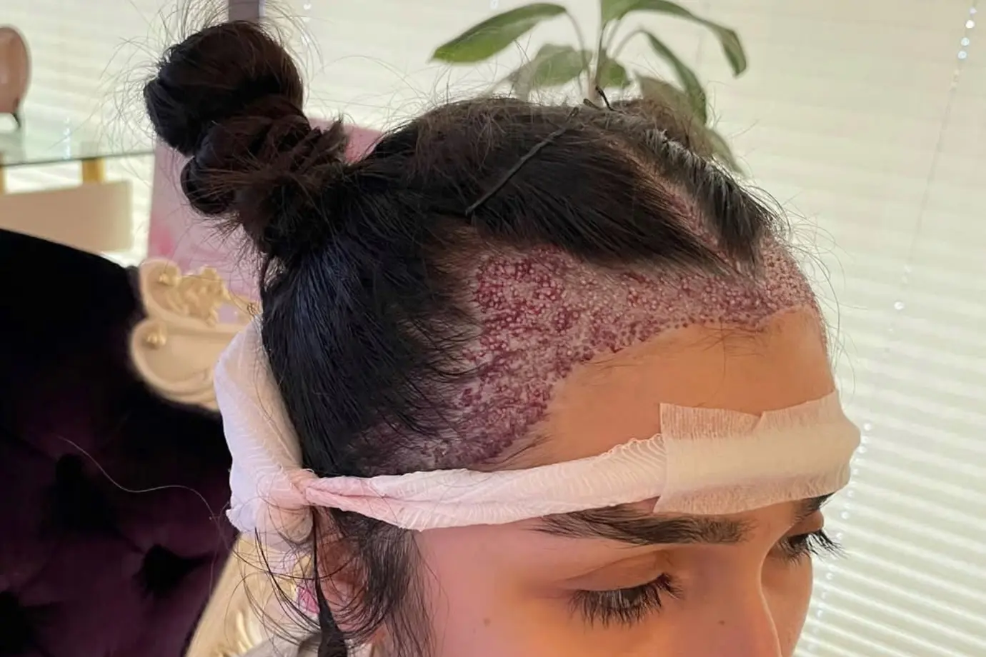 Female Hair Transplant